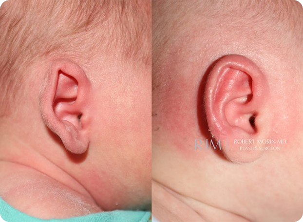 Earwell Before and After