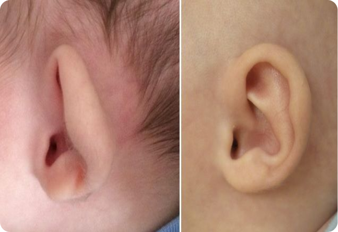 Earwell Before and After