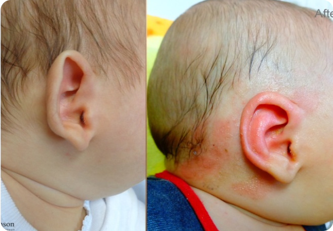 Earwell Before and After