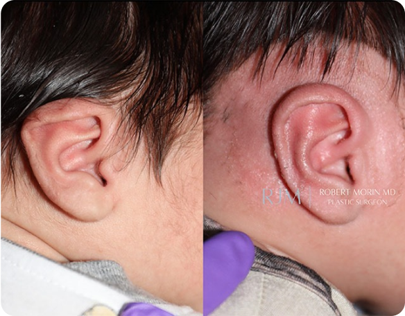 Earwell Before and After