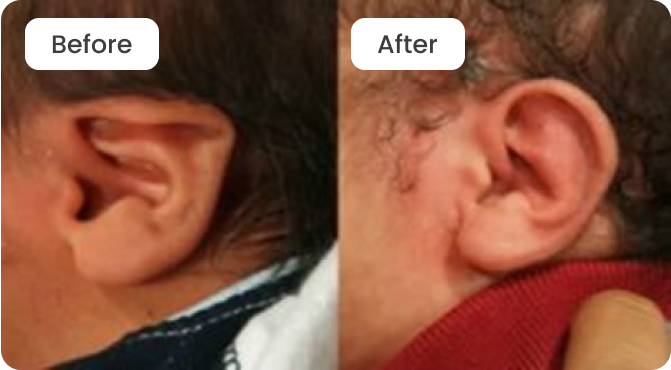 Ear Deformity Before and After