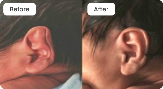 Ear Deformity Before and After
