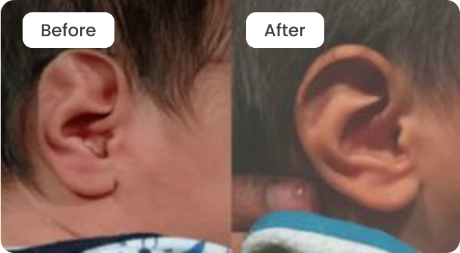 Ear Deformity Before and After
