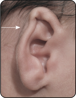 HELICAL RIM