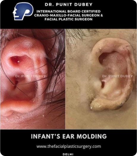 Earwell in India