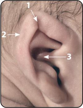 MIXED DEFORMITIES