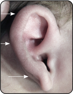 PROMINANT EAR