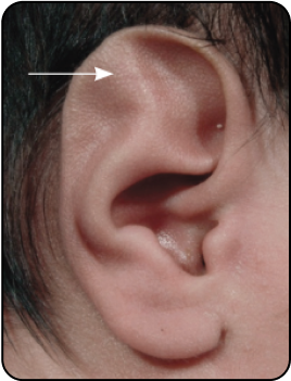 STAHL’S EAR