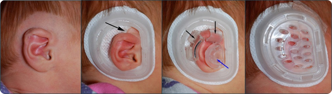 Before and after application of EarWell